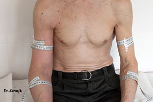 Лімфостаз до лікування у чоловіка Лімфостаз до лікування у чоловіка