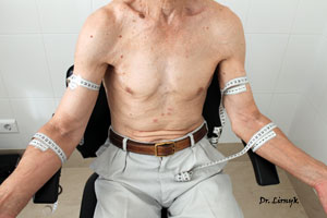 Лімфостаз після лікування у чоловіка Лімфостаз після лікування у чоловіка