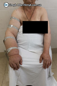 Постмастектомний синдром до лікування Постмастектомний синдром до лікування