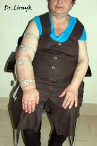 Постмастектомний синдром після лікування Постмастектомний синдром після лікування