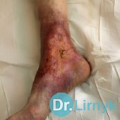 Трофічна виразка 4