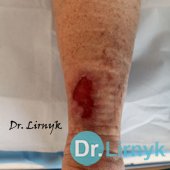 Виразка Марторелла 