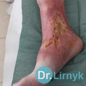 Początek leczenia. Prawa końcówka dolna.