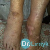 Трофічна виразка 6