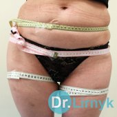 Целюліт до лікування 1 1a