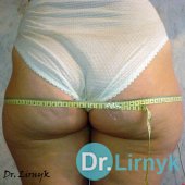 Целюліт до лікування 2а