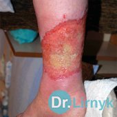 Гіпертонічна виразка (виразка Марторелла): до і після лікування