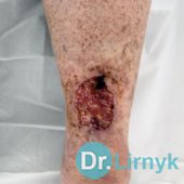 Виразка Марторелла на початку лікування