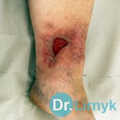 Трофічна виразка 5