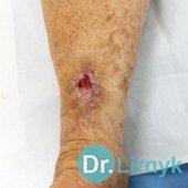 Martorell syndrome: in the course of treatment