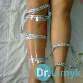 Лімфостаз: до і після лікування