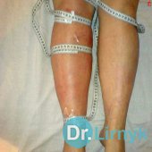 Obrzęk limfatyczny: po kursie leczenia. Przeprowadzono  7 seansów. Wynik: - 4 cm