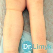 Лимфостаз после онкогинекологической операции и лучевой терапии.