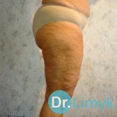 До лікування