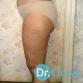 Після лікування