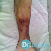 Варикозна хвороба: до і після лікування