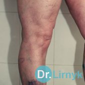 Ретикулярний варикоз до лікування