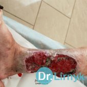 Початок лікування. Пацієнтці 70 років