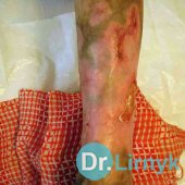 Трофічна виразка: закінчення лікування, загоєння виразок