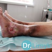 Wrzód troficzny lewej goleni (górna powierzchnia) przyjęciu do kliniki