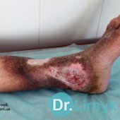 Wrzód troficzny lewej goleni po wewnętrznej powierzchni.