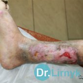 Результат через 2 місяці лікування