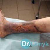 Плановий огляд через 10 місяців лікування