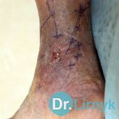 Partycjonowanie przed operacją