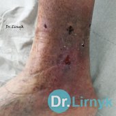 Zakończenie leczenia. Usunięte szwy. Polepszenie obiegu krwi w strefie zaburzeń troficznych