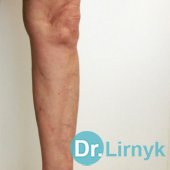 Варикозна хвороба після лікування