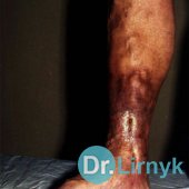 Żylakowy wrzód: po środku leczenia