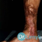 Żylakowy wrzód: koniec nadzorowanego leczenia