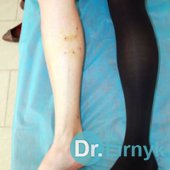 Через 5 днів: амбулаторна операція – короткий стрипінг. Операція виконана під загальною анестезією. Після операції пацієнтка змогла самостійно піти додому