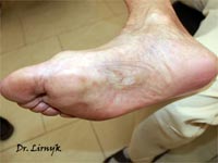 Трофічна артеріальна виразка результат лікування Трофічна артеріальна виразка результат лікування