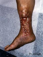 Варикозна трофічна язва до лікування Варикозна трофічна язва до лікування