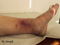 Трофічна виразка результат лікування Трофічна виразка результат лікування