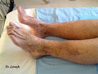 Трофічна виразка результат лікування Трофічна виразка результат лікування