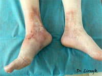 Трофічна виразка результат лікування Трофічна виразка результат лікування