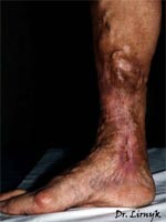 Варикозна трофічна язва результат консервативного лікування Варикозна трофічна язва результат консервативного лікування